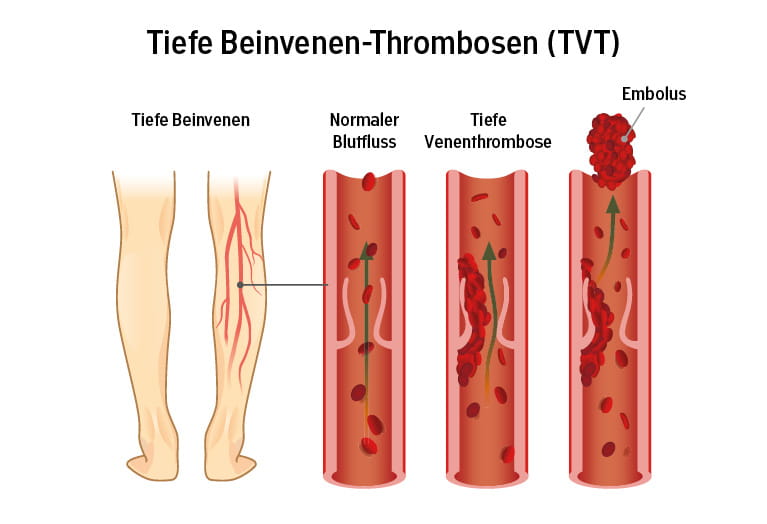 Illustration tiefer Beinvenen und ihre Blutfluss normal vs. Verstopfung